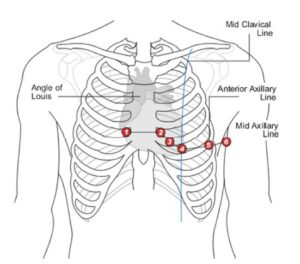 image of chest plaement for ECG leads